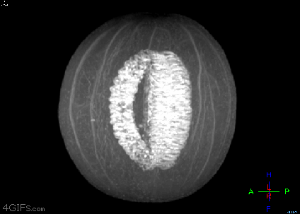 Cantaloupe_MRI