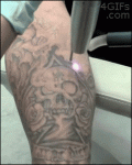 Laser-tattoo-removal